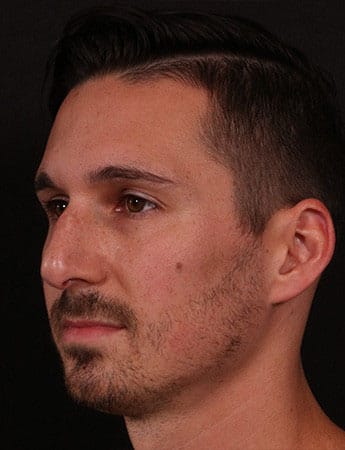 Before Image: Rhinoplasty - left-front-oblique