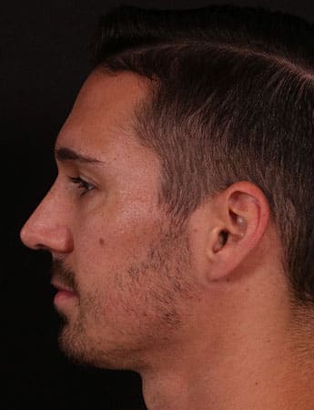 After Image: Rhinoplasty - left-side