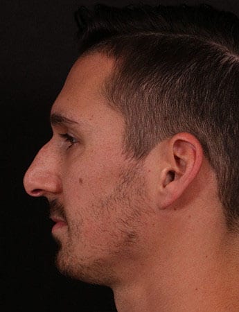 Before Image: Rhinoplasty - left-side