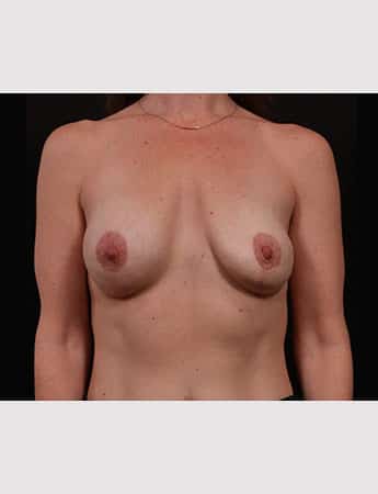 Before Image: Secondary Breast Enhancement - front