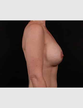After Image: Secondary Breast Enhancement - right-side