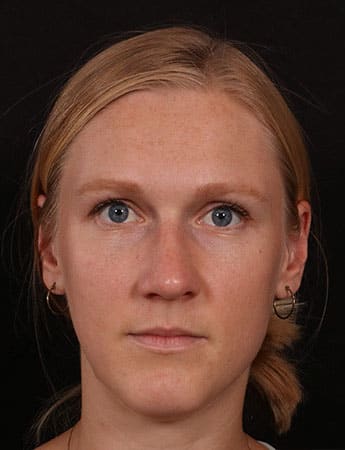 After Image: Rhinoplasty - front