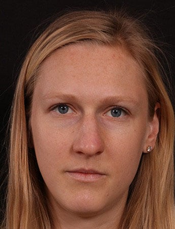 Before Image: Rhinoplasty - front