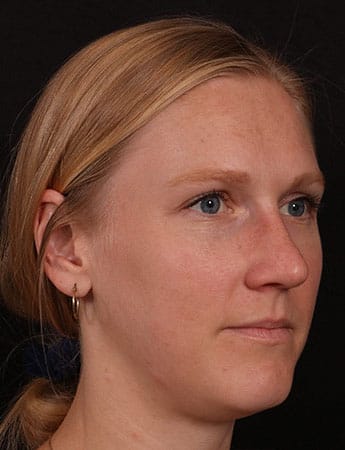 After Image: Rhinoplasty - right-front-oblique