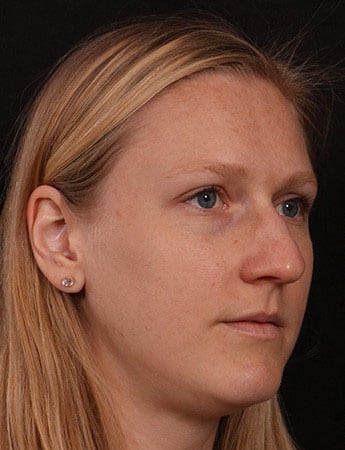Before Image: Rhinoplasty - right-front-oblique