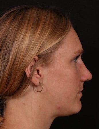 After Image: Rhinoplasty - right-side