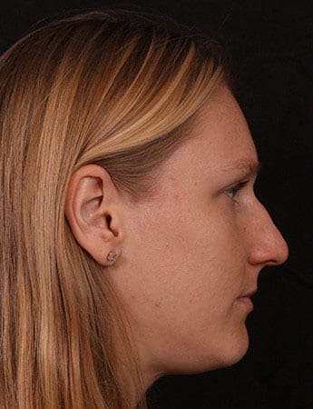 Before Image: Rhinoplasty - right-side