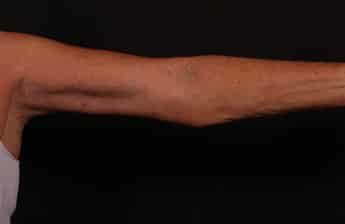 After Image: Brachioplasty (Arm Lift) - front