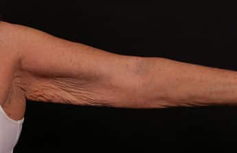 Before Image: Brachioplasty (Arm Lift) - front