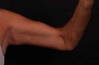 After Image: Brachioplasty (Arm Lift) - front