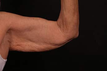 Before Image: Brachioplasty (Arm Lift) - front