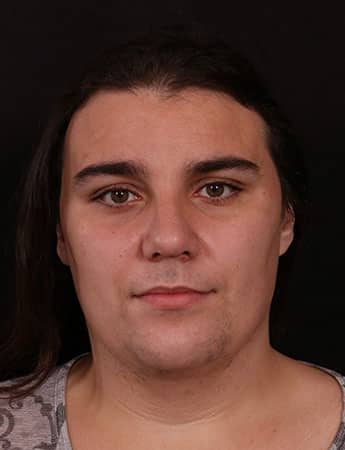After Image: Rhinoplasty - front