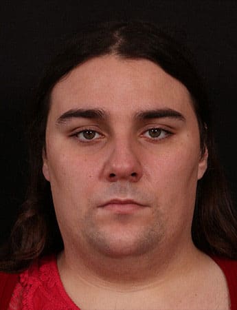 Before Image: Neck Liposuction - front