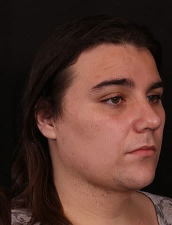 After Image: Neck Liposuction - right-front-oblique
