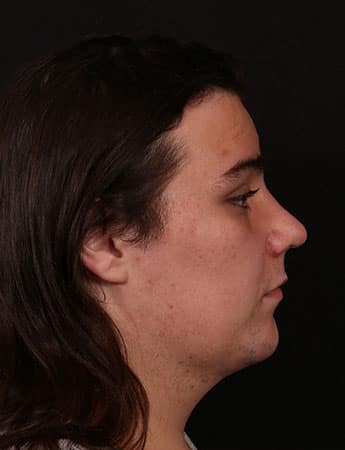After Image: Neck Liposuction - right-side