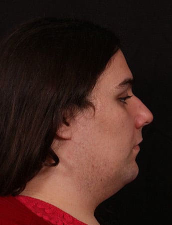 Before Image: Neck Liposuction - right-side