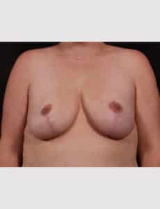 Breast Reduction