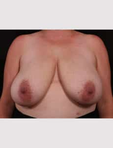 Breast Reduction