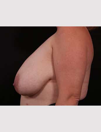 Before Image: Breast Reduction - left-side