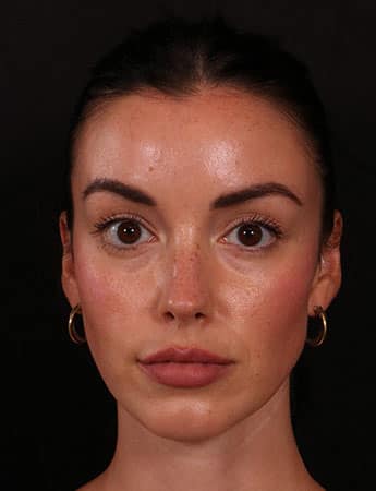 After Image: Chin Implant - front