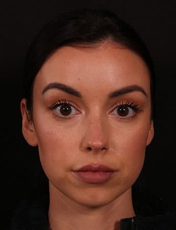 Before Image: Chin Implant - front