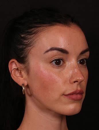 After Image: Buccal Fat Removal - right-front-oblique
