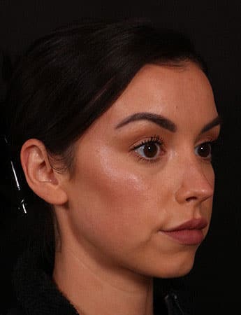 Before Image: Buccal Fat Removal - right-front-oblique