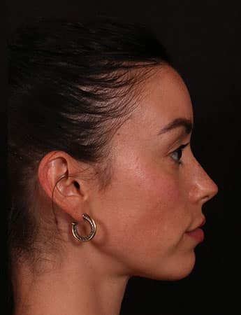 After Image: Buccal Fat Removal - right-side