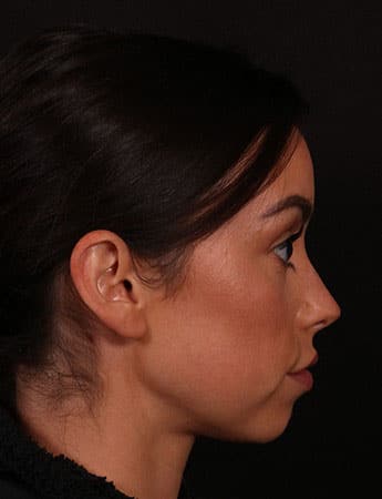 Before Image: Buccal Fat Removal - right-side