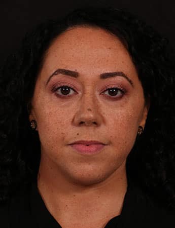 After Image: Female Neck Lift / Lower Facelift - front