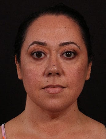 Before Image: Female Neck Lift / Lower Facelift - front
