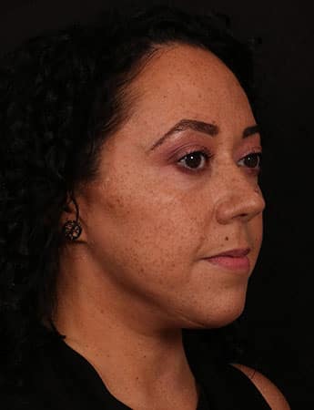 After Image: Female Neck Lift / Lower Facelift - right-front-oblique