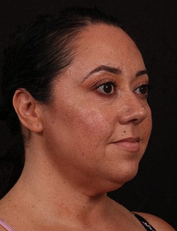 Before Image: Female Neck Lift / Lower Facelift - right-front-oblique
