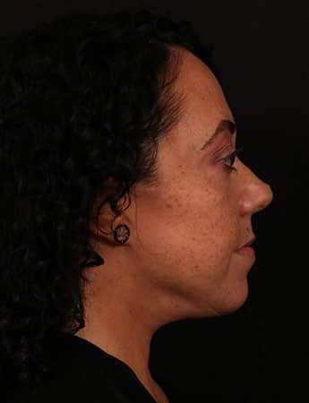 After Image: Female Neck Lift / Lower Facelift - right-side