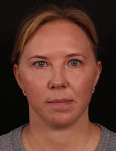Lower Facelift