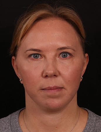 After Image: Lower Facelift - front