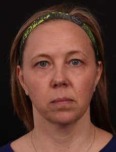 Lower Facelift