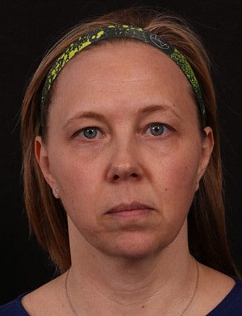 Before Image: Lower Facelift - front