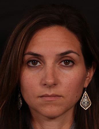 After Image: Rhinoplasty - front