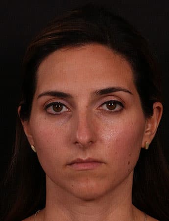 Before Image: Rhinoplasty - front