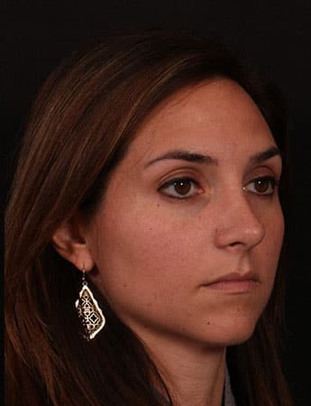 After Image: Rhinoplasty - right-front-oblique