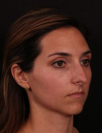 Before Image: Rhinoplasty - right-front-oblique