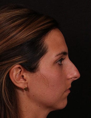 Before Image: Rhinoplasty - right-side