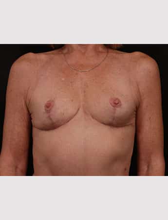 After Image: Secondary Breast Enhancement - front