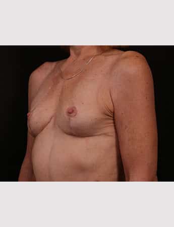 After Image: Secondary Breast Enhancement - left-front-oblique