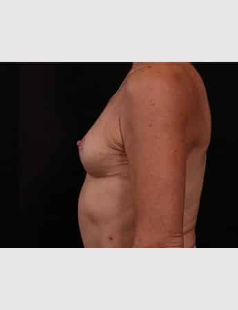 After Image: Secondary Breast Enhancement - left-side