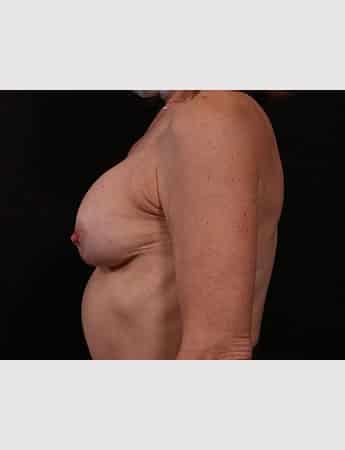 Before Image: Secondary Breast Enhancement - left-side