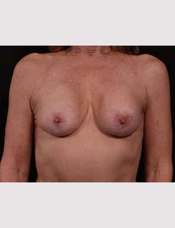 Before Image: Implant Removal - front