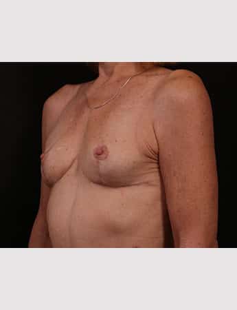 After Image: Implant Removal - left-front-oblique