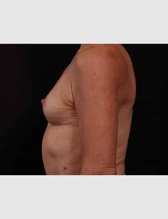 After Image: Implant Removal - left-side